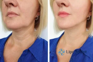 Double chin before and after Hi-Fu treatment 4 Book your double chin treatment Stourbridge today! We are here to help!