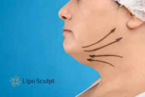 Double chin before and after Hi-Fu treatment 3 Boost your confidence with a Double chin treatment Stourbridge
