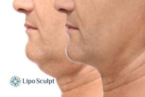 Double chin before and after Hi-Fu treatment 2 Double chin treatment Stourbridge from Lipo Sculpt - feel more confident today!