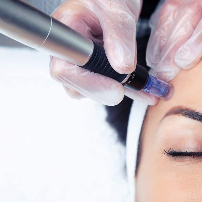 Morpheus8 treatment Stourbridge from Lipo Sculpt - Book in today!